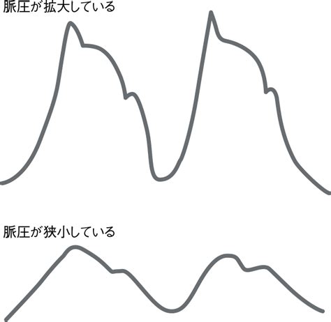 観血的動脈圧測定 | 看護roo![カンゴルー]