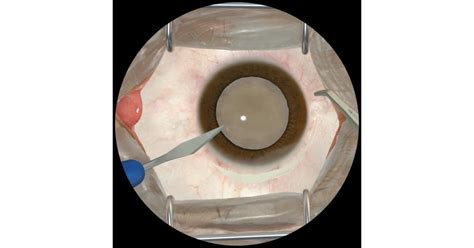 Image result for Eye Surgery Simulation