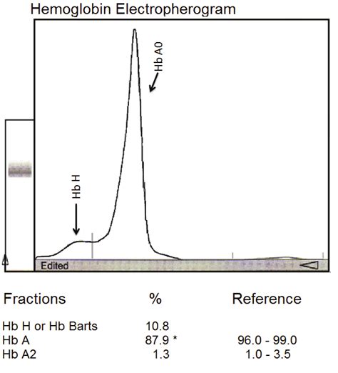 Image result for Electropherogram vs Chromatogram