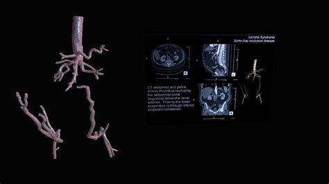 Aorto-iliac Occlusive Disease - 3D model by tl0615 [fda56f3] - Sketchfab