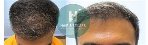 Case Study of Hair Transplant in a 32 year old male patient, hairloss ...