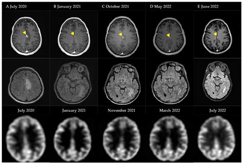 Low-Dose Bevacizumab for the Treatment of Focal Radiation Necrosis of ...