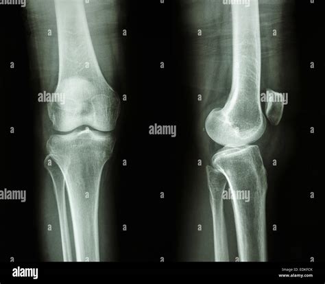 Normal Knee X Ray Stock Photos & Normal Knee X Ray Stock Images - Alamy