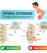 Image result for Stenosis
