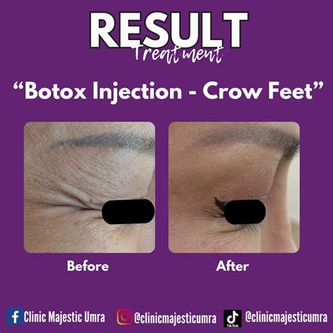 Majestic at UMRA | BOTOX CROW FEET