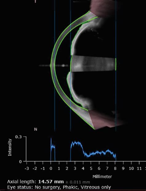 Image result for Biometry Eye Surgery