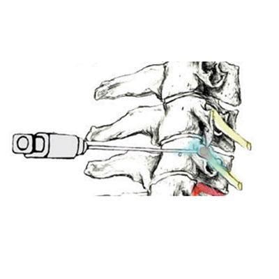 Image result for Selective Nerve Root Block vs Transforaminal