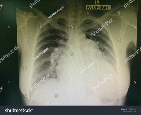 Abnormal Chest Xray Cardiomegaly Pulmonary Hypertension Foto stock ...