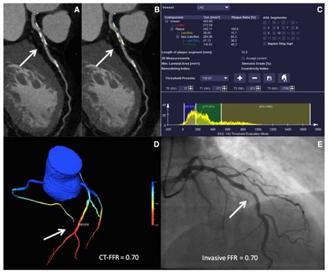 Artificial Intelligence in Coronary Artery Disease | Encyclopedia MDPI