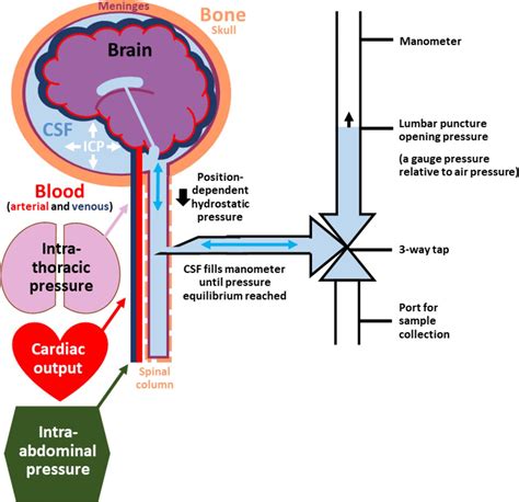 How to use lumbar puncture manometry in children | ADC Education ...