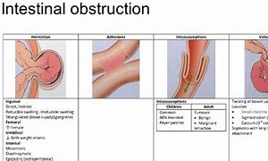 Image result for intestinal obstruction