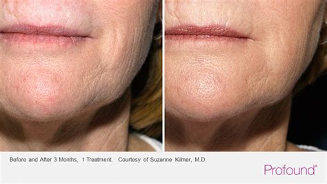 Image result for Profound Face Procedure