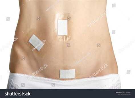 Image result for Appendix Surgery Scar