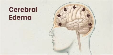 A Guide To AMS, HAPE and HACE Prevention For High-altitude Trekking