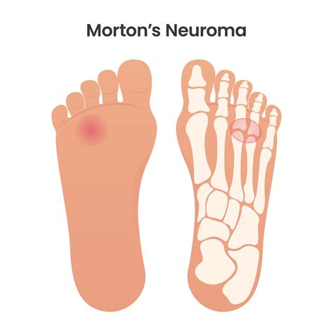 Morton's Neuroma Symptoms
