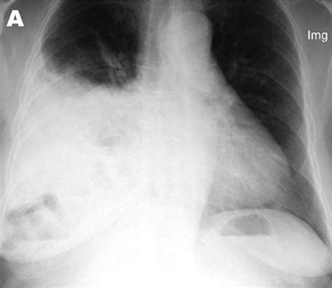 Symptomatic Bochdalek hernia in an adult patient | BMJ Case Reports