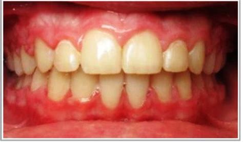 Best Dental Clinic in Borivali Mumbai | Root Canals | Implants