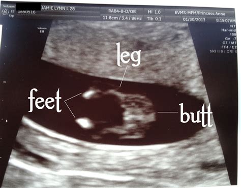 How To Read An Ultrasound Picture At 12 Weeks at Jordan Bullard blog