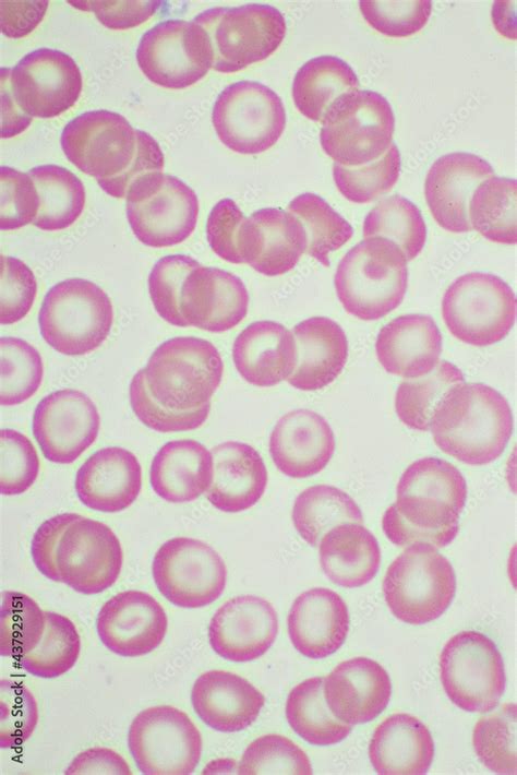 Target cells with abnormal red blood cells in blood smear, specimen from thalassemia patient ...