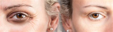 Botox Services 的图像结果