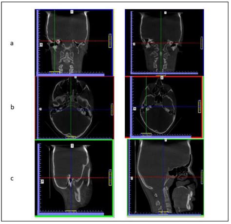 Frontal and Axial Evaluation of Craniofacial Morphology in Repaired ...