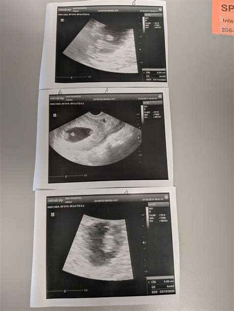 7 Week Ultrasound Identical Twins