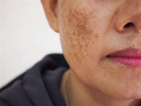 Melasma vs Freckles / Sun Spots | Affiliated Dermatology