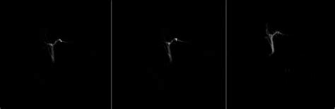 Image result for MRCP Biliary Tree