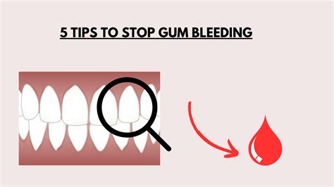 How to Stop Gum Bleeding at Home immediately (5 tips)