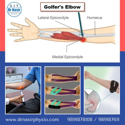 Nyc Golf Elbow Medial Epicondylitis Treatment Doctor Golfer's
