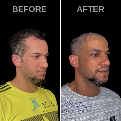 Facial Masculinization Surgery - Dr. MFO - FFS Surgeon in Turkey