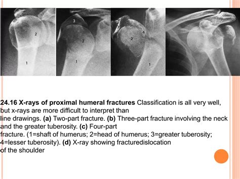 Proximal humerus fractures | PPTX