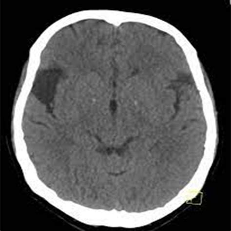 Rivaroxaban for Inherited Thrombophilia and Stroke