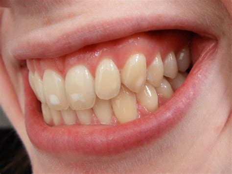 Eleven tips to treat white spots on teeth - Lee Simon