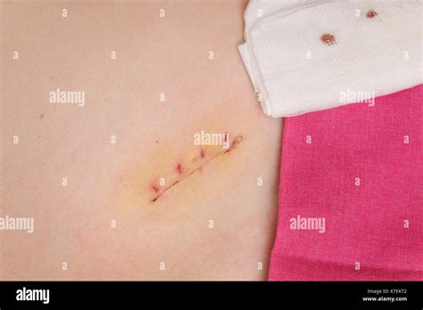 Image result for Appendix Surgery Scar