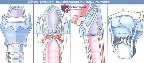 Методы открытых операций при раке гортани