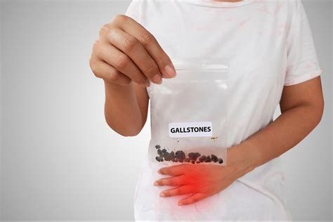 Gallbladder Stones: Navigating the Path to Treatment without Surgery