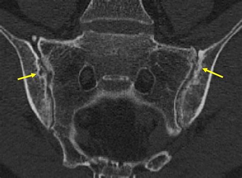 Axiale Spondyloarthritis: MRT-Diagnostik in der Praxis - Rheumatologie ...