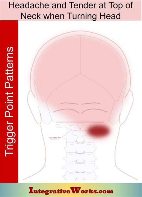 Headache with Tender Top of Neck While Turning - Integrative Works
