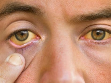 yellow eye to swelling face can be early signs of fatty liver on face ...