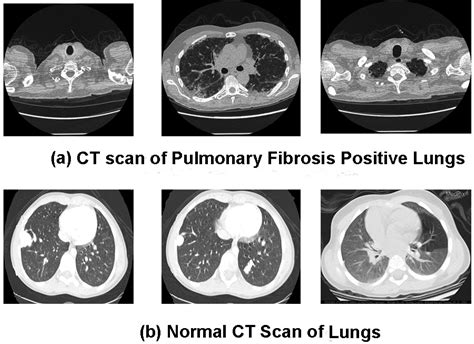 Deep Transfer Learning Techniques-Based Automated Classification and Detection of Pulmonary ...
