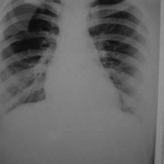 Image result for First Rib Resection Surgery