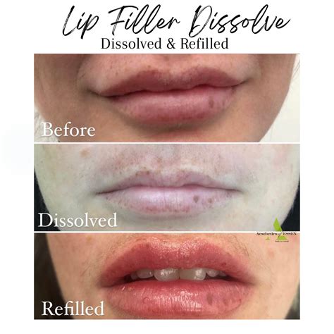 How Do Lip Fillers Dissolve at Max Renwick blog