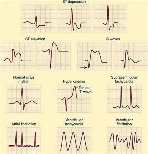 Normal Vs Abnormal Ecg
