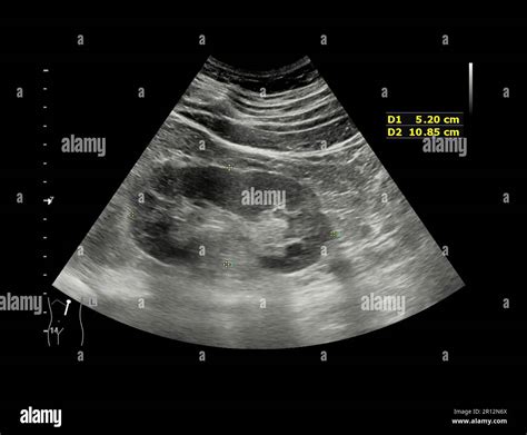 Kidney stone ultrasound hi-res stock photography and images - Alamy