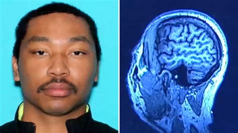 CTE Brain 的图像结果