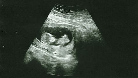 What Is The 12 Week Ultrasound For at Ronald Piper blog