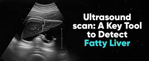Non-Alcoholic Fatty Liver Disease (NAFLD): Symptoms & Treatment