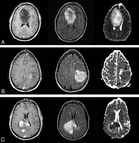 Update on Brain Tumor Imaging: From Anatomy to Physiology | American Journal of Neuroradiology