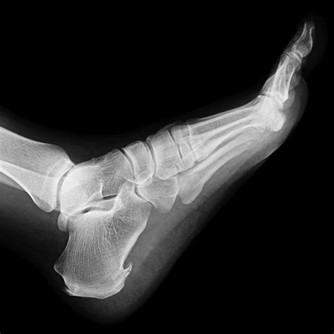 Heel Xray Labeled at John Gaffney blog